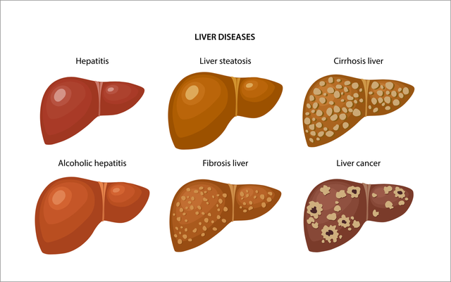 The Safety of Apixaban in Patients with Liver Disease