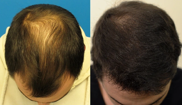 How to Maximize the Benefits of Finasteride for Hair Loss