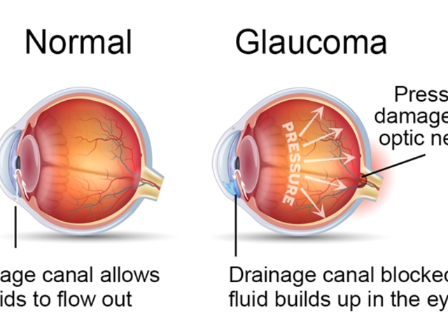 The Role of Loteprednol in Glaucoma Treatment